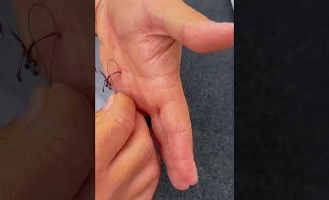 How To Remove A Hook (Deep In The Hand) #shorts