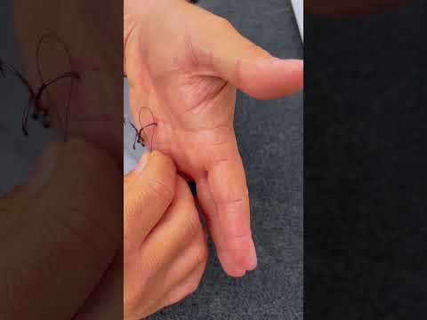 How To Remove A Hook (Deep In The Hand) #shorts